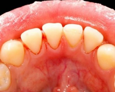 牙龈出血是什么原因（牙龈出血的原因有哪些）