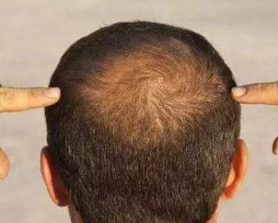我国脱发人群超2.5亿 导致脱发的主要原因