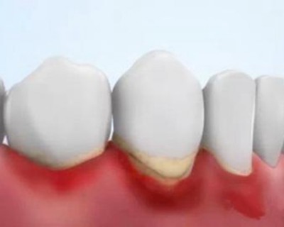 牙龈肿痛怎么办？养成好习惯不可忽视口腔卫生！