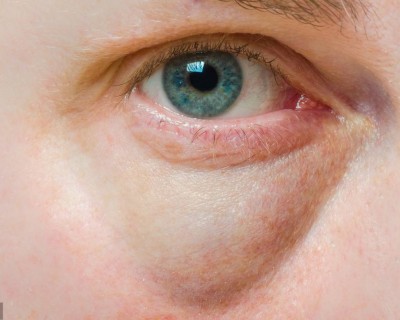 眼睛肿是什么原因（眼睛浮肿是怎么回事？）