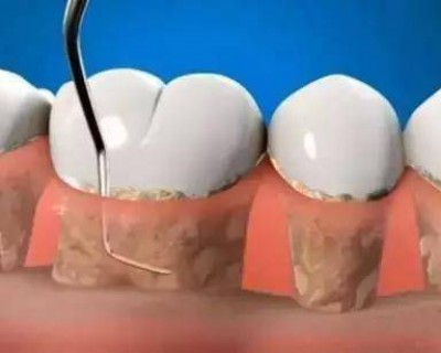 牙科洗牙一般多少钱(大门牙中间缝隙黑了怎么办)